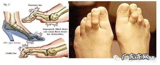 跑步后小腿变粗怎么恢复?