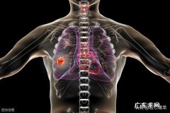 有人说，有没有肺癌，看手指就能知道，要怎样看？ 如果自己得肺癌手指有何征兆