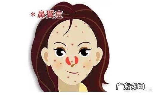 脸上有痘痘真的是内分泌失调吗