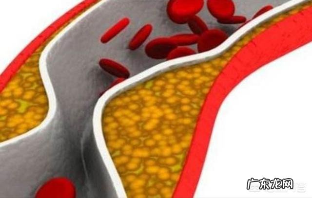 体型瘦的人也会血脂高、血压高吗