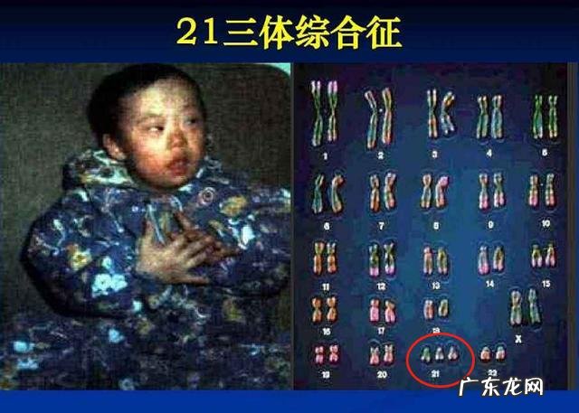 孕妇只要注意三点就不会有黄疸 孕期注意什么小孩出生不会有黄疸