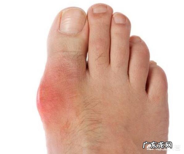 痛风患者能否采用生酮饮食方法?