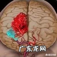 脑梗死的二次复发该怎样进行预防