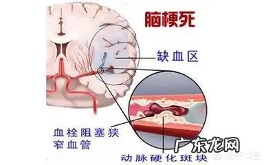 脑梗死的二次复发该怎样进行预防