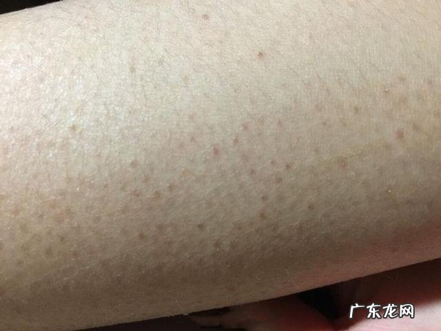 如何有效的去除身上的“鸡皮肤”？
