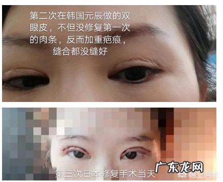 对于割双眼皮,你怎么看?