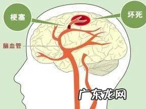 血液粘稠,该如何预防脑梗