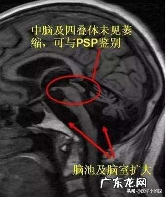 脑萎缩一般多大年龄会出现?该注意什么?