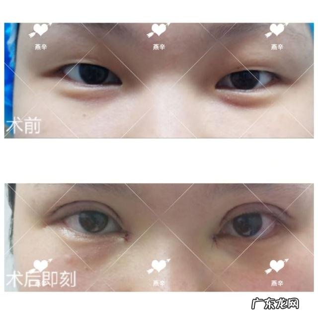 全切双眼皮和开眼角后多久能运动健身?