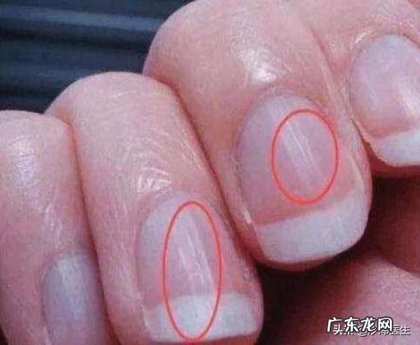 指甲表面有明显的竖纹是怎么回事?