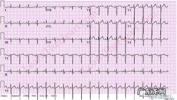 心脏跳速增加会影响人的寿命吗?为什么?