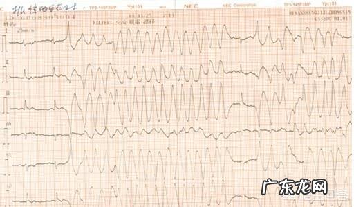 心脏跳速增加会影响人的寿命吗?为什么?
