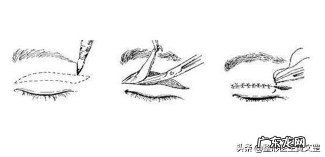 最常见双眼皮的术式是什么 双眼皮术式介绍