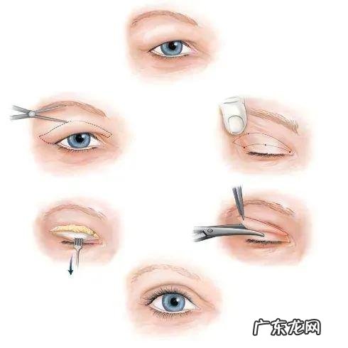 双眼皮手术后5天怎么护理 做完双眼皮手术后怎么护理