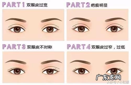 双眼皮手术哪种较自然 双眼皮手术几种方法及优劣
