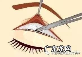 割双眼皮提升术 双眼皮收紧术