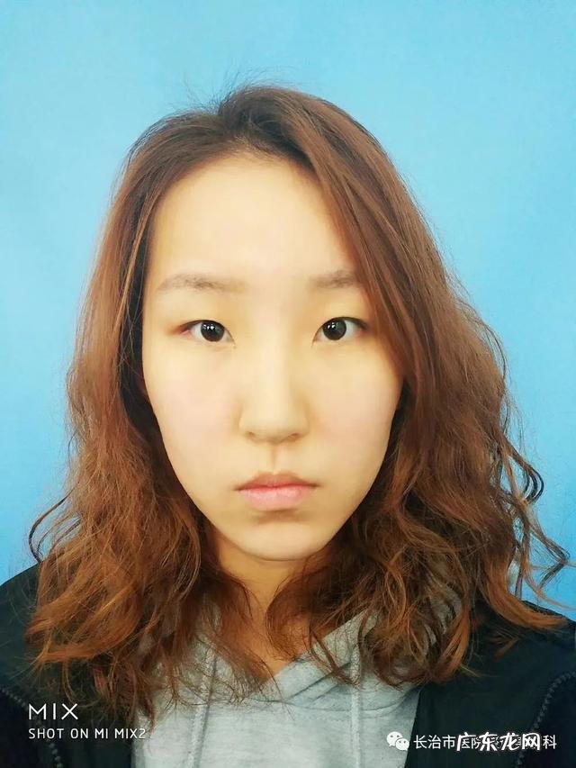 割双眼皮提升术 双眼皮收紧术