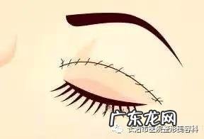 割双眼皮提升术 双眼皮收紧术