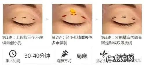 割双眼皮提升术 双眼皮收紧术