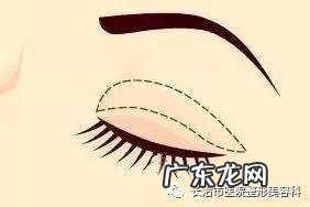 割双眼皮提升术 双眼皮收紧术