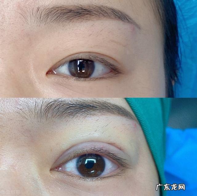双眼皮失败修复免费吗 双眼皮割失败了可要求免费修复吗