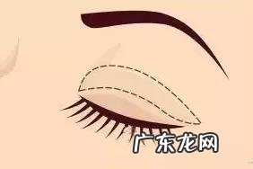 做双眼皮全切几天能恢复好 割双眼皮全切多长时间能恢复正常