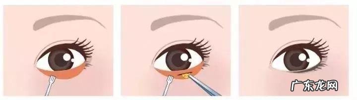 开眼角加割双眼皮费用一般是多少 开眼角做双眼皮割眼袋一般多少钱