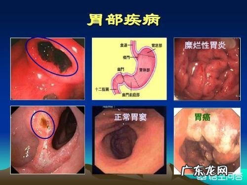 糜烂性胃炎，现在一吃东西就胃胀，该怎么办？ 糜烂性胃炎吃点饭就胀怎么办