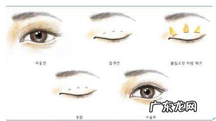 双眼皮手术主要有三种 常见的双眼皮手术方法有哪几种啊