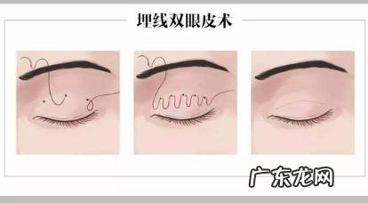 双眼皮手术主要有三种 常见的双眼皮手术方法有哪几种啊