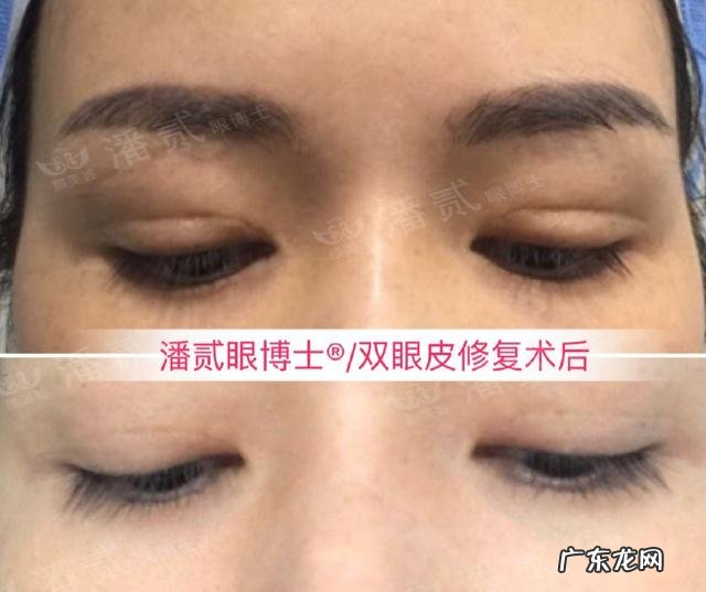 切双眼皮术要多少钱啊 做双眼皮术大概多少钱啊