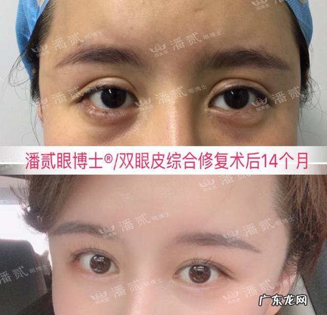 切双眼皮术要多少钱啊 做双眼皮术大概多少钱啊