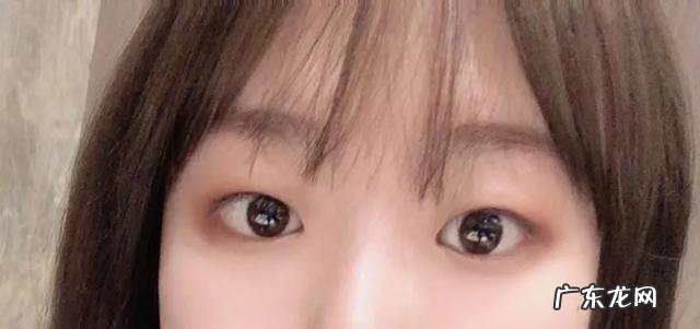 割完双眼皮5个月后的效果 割完双眼皮25天效果