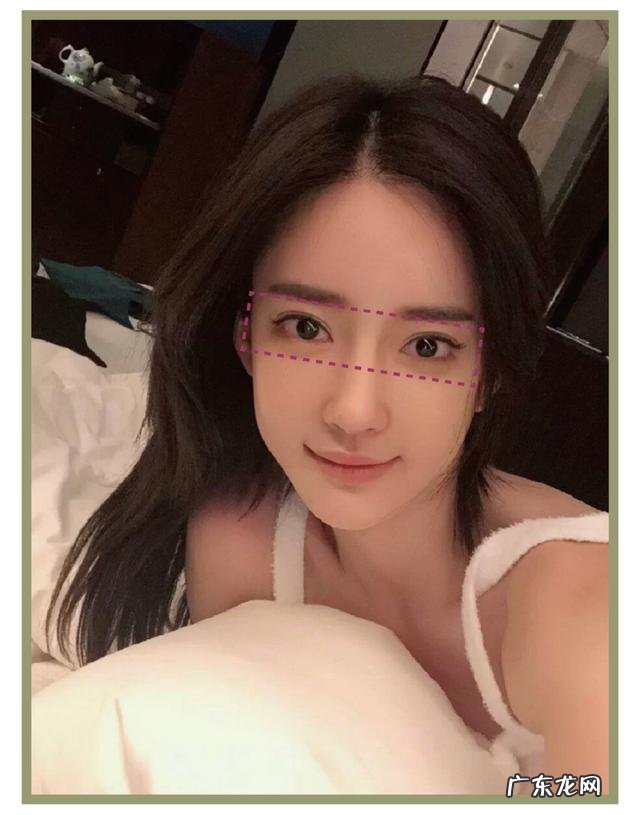 割完双眼皮5个月后的效果 割完双眼皮25天效果