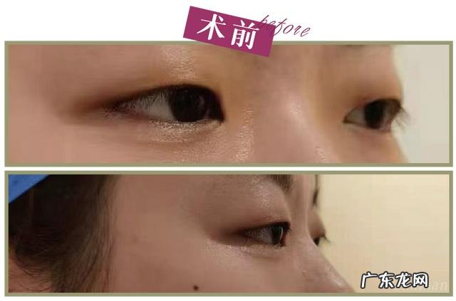 割完双眼皮5个月后的效果 割完双眼皮25天效果