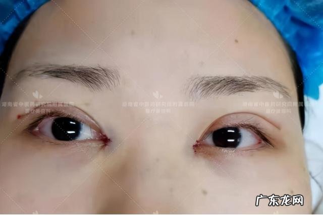 双眼皮手术方式大全 双眼皮手术方法有哪些