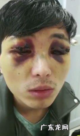 割双眼皮失败爆笑图片 双眼皮整形失败几率