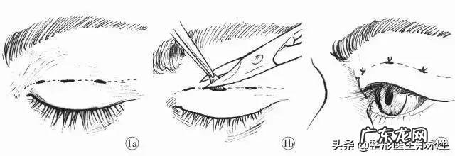 双眼皮手术的几种类型和建议 双眼皮手术三种方法的优缺点