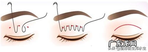 双眼皮手术的几种类型和建议 双眼皮手术三种方法的优缺点