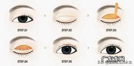 双眼皮手术的几种类型和建议 双眼皮手术三种方法的优缺点