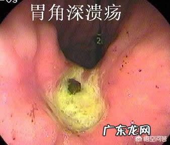 胃溃疡与十二指肠溃疡在临床表现上有哪些异同