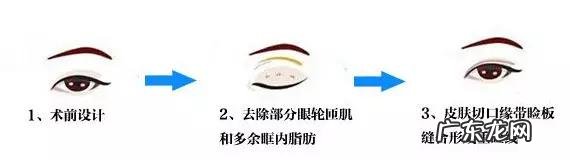 不开刀双眼皮手术十分钟 十秒钟看懂双眼皮手术