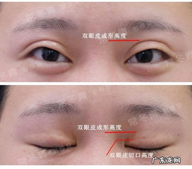 双眼皮修复手术日记 双眼皮修复手术前后的真实情况