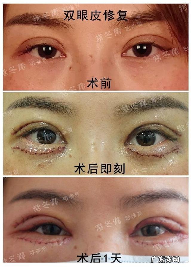 双眼皮修复手术日记 双眼皮修复手术前后的真实情况
