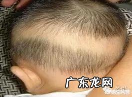 宝宝补着钙还有草帽圈，这是什么原因呢？