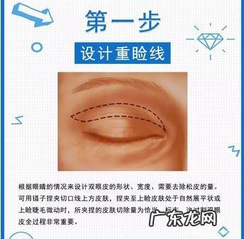 微创双眼皮还是全切双眼皮贵 微创切开双眼皮跟全切双眼皮区别