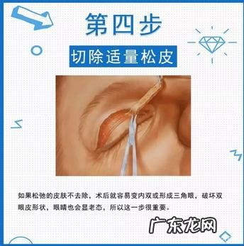 微创双眼皮还是全切双眼皮贵 微创切开双眼皮跟全切双眼皮区别