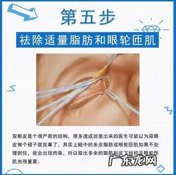 微创双眼皮还是全切双眼皮贵 微创切开双眼皮跟全切双眼皮区别