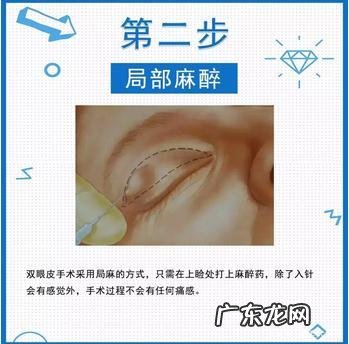 微创双眼皮还是全切双眼皮贵 微创切开双眼皮跟全切双眼皮区别