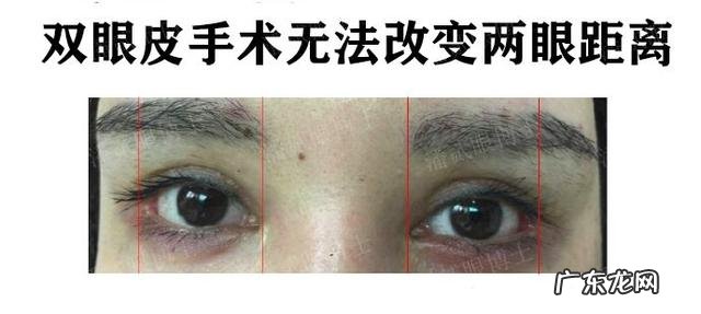 割双眼皮注意啥 割双眼皮以后注意什么